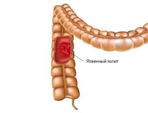 Воспаление толстого. Неспецифический язвенный колит кишка. Неспецифический язвенный колит стенка.
