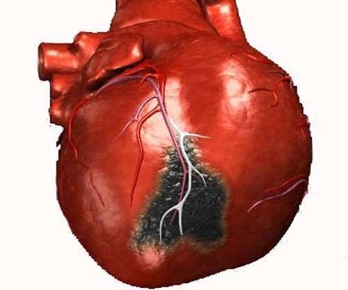 инфаркт симптомы и первая помощь