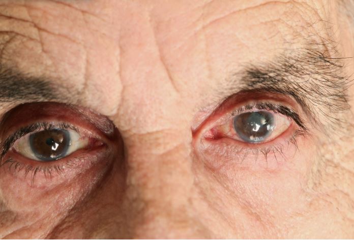 Что такое катаракта и чем она опасна?