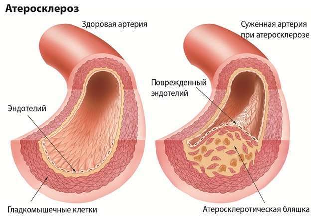атеросклероза центральных артерий