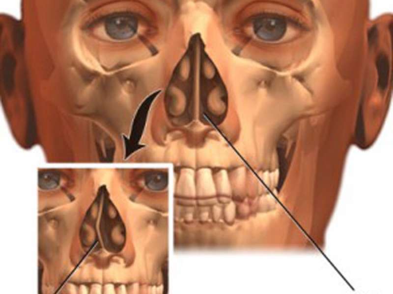 Тяжкие телесные повреждения перелом носа thumbnail