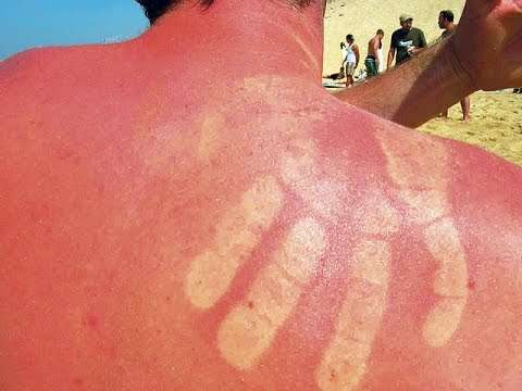Симптомы обгоревшей кожи