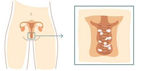 Симптомы и лечение дисбактериоза женских органов