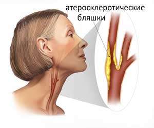 Причины атеросклероза артерий шеи