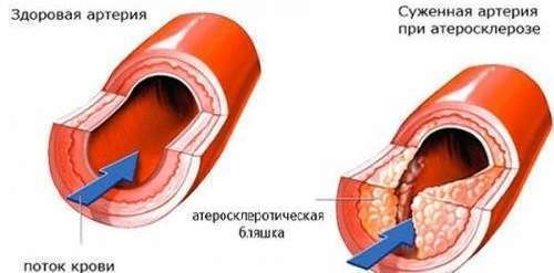 Склероз аорты. Артерии: сужены, склерозированы. Аорта склерозирована что это значит. Стенка аорты склерозирована, что значит.