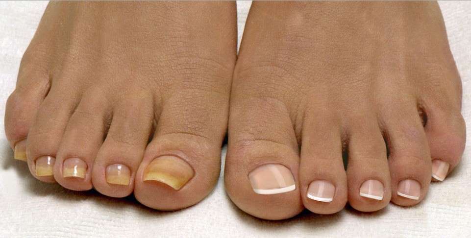 Лечение медным купоросом: грибок ногтей