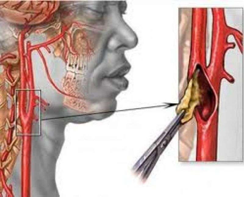 Атеросклероз экстракраниальных артерий головы: описание и симптомы