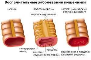 язвенный неспецифический колит симптомы