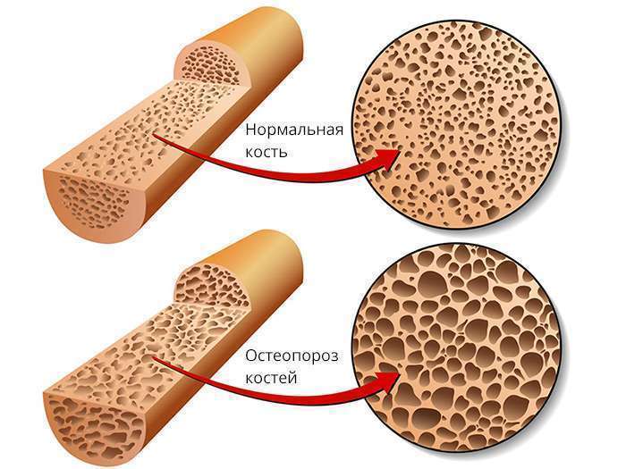 денситометрия остеопороз обследование 