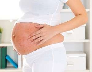 псориаз лечение во время беременности