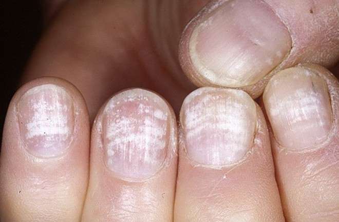 псориаз ногтей пальцев рук медикаментозное лечение