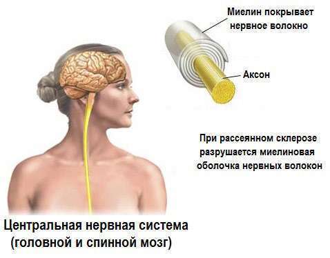 Рассеянный склероз первые признаки и начальный возраст