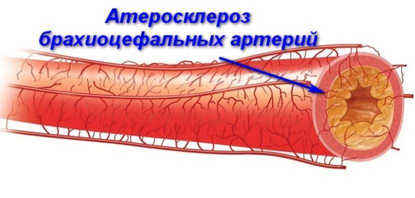 Проявления симптомов атеросклероза брахиоцефальных артерий
