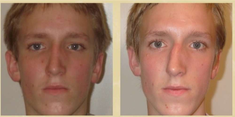 Изменились в сторону увеличения на. Перелом скуловой кости асимметрия лица-. Исправление асимметрии лица. Коррекция асимметрии лица.