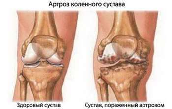 Вот как выглядит артроз коленного сустава. Фото с сайта www.zdorovie29.ru