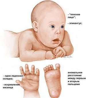 Внешние признаки детей с синдромом Дауна. Фото с сайта vse-pro-geny.com
