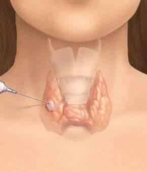 Щитовидная железа: киста – симптомы, причины, лечение