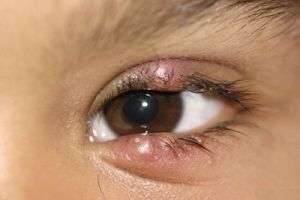 Как вылечить ячмень на глазу у детей быстро и безболезненно