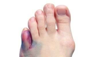 Как лечить ушиб пальца на ноге: подробное руководство и рекомендации