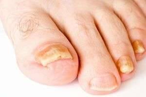 Как и чем вылечить запущенный грибок пальцев и ногтей на ногах?
