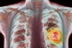 Что такое рак легких. Первые признаки рака легких