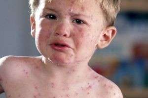 Причины появления красных пятен на теле у ребенка (больших и маленьких, шершавых и шелушащихся, зудящих)