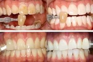Методы отбеливания зубов: народные и клинические способы
