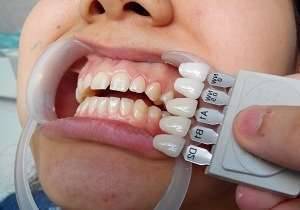 Что такое виниры для зубов?