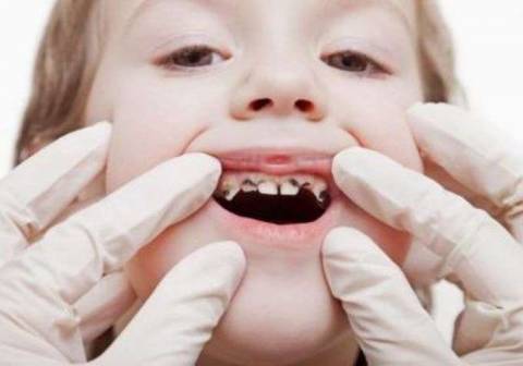 Причины почернения зубов и методы их устранения