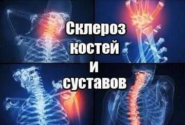 Склероз суставов и костей